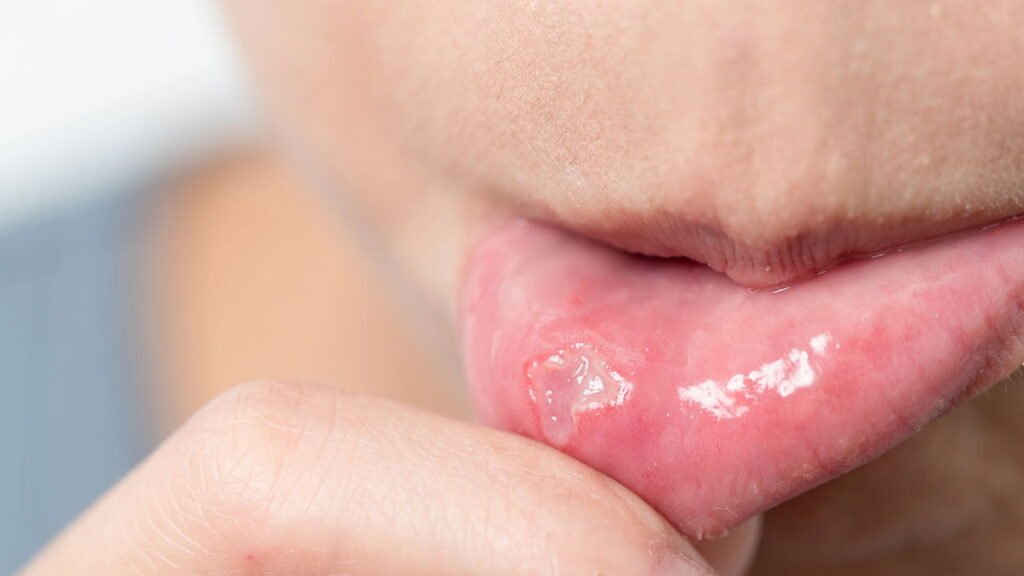 O problema silencioso que aparece na boca e como resolver com 5 alimentos