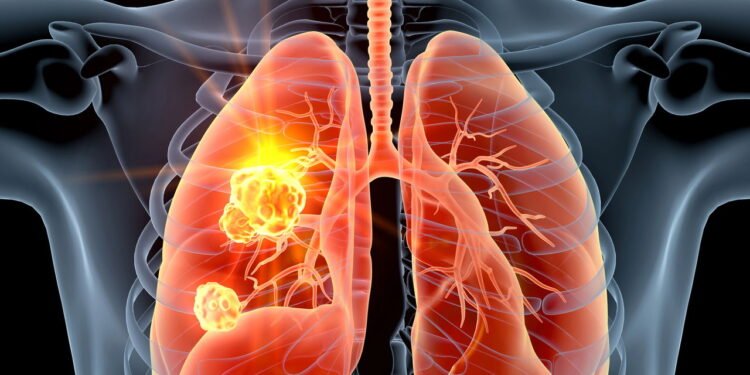 infecção pulmonar - Créditos: depositphotos.com / Axel_Kock