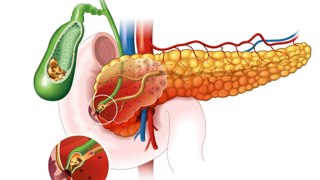 14.000 novos casos a cada ano: os sinais de alerta de que seu pâncreas está falhando