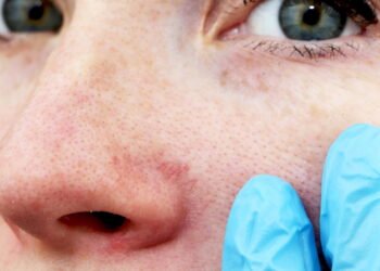 Nariz ressecado pode piorar com remédios? Saiba mais