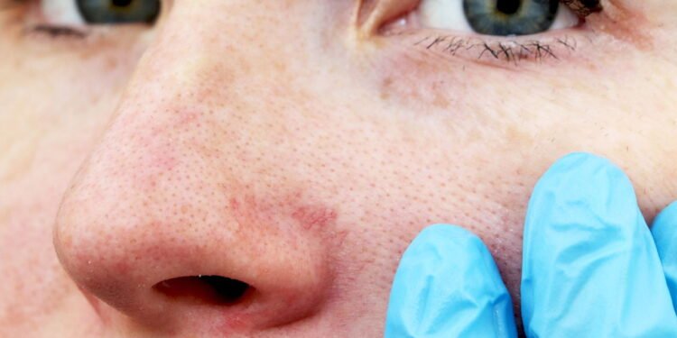 Secura Nasal - Créditos: depositphotos.com / Alena1919