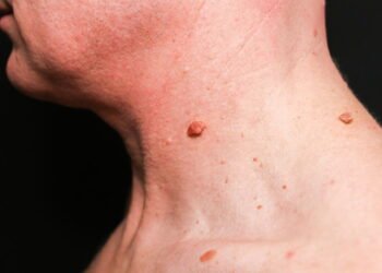 Como remover verrugas do pescoço?