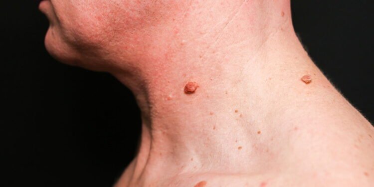 Como remover verrugas do pescoço?