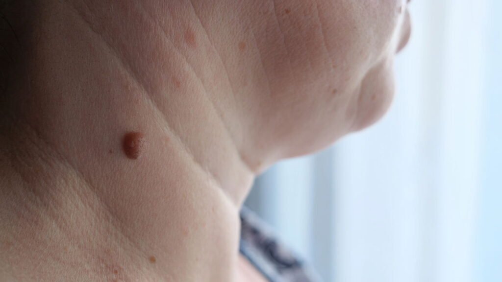 Como remover verrugas do pescoço?