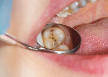 Alimentos que ajudam a prevenir cáries