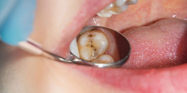 Cárie Dentária - Créditos: depositphotos.com / schigirin91@gmail.com