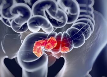 Câncer colorretal: um sintoma que não deve ser ignorado para detectar a doença foi identificado