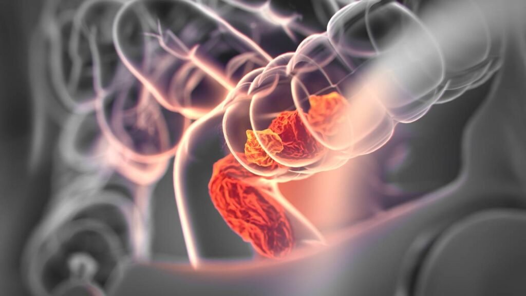 Câncer colorretal: um sintoma que não deve ser ignorado para detectar a doença foi identificado