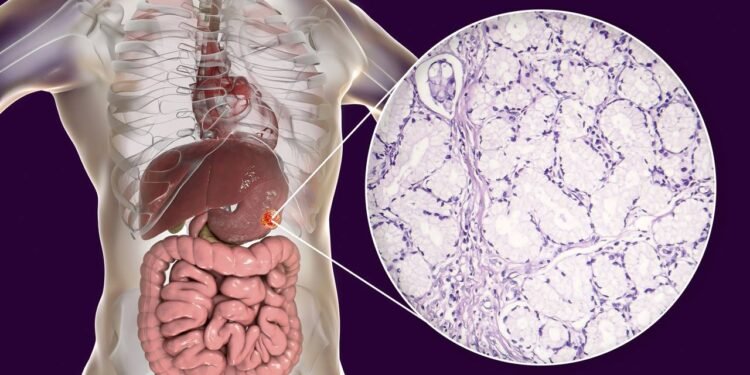 Câncer gástrico: como reconhecer os sintomas e quais mudanças na dieta os especialistas aconselham