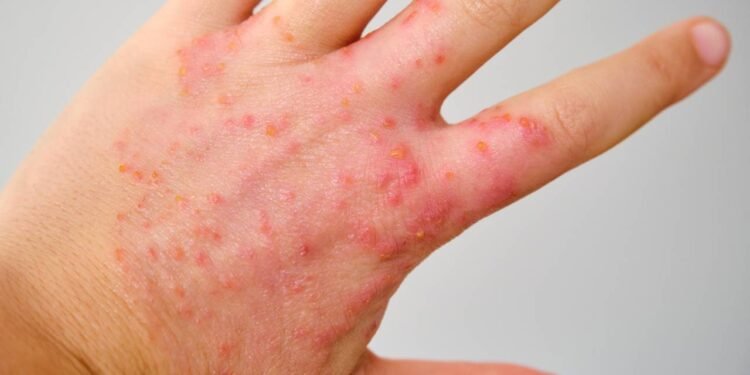 Essa mudança de pele negligenciada pode significar que você está comendo muito açúcar