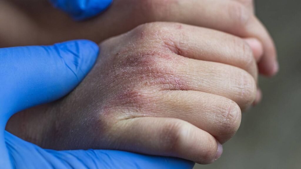 Essa mudança de pele negligenciada pode significar que você está comendo muito açúcar