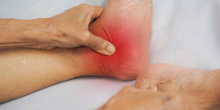 Dor no calcanhar pode ter alívio rápido com palmilhas e alongamentos certos