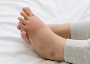 Como evitar pés inchados em viagens longas de avião ou carro