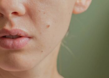 O que significa ter uma pinta perto da boca?