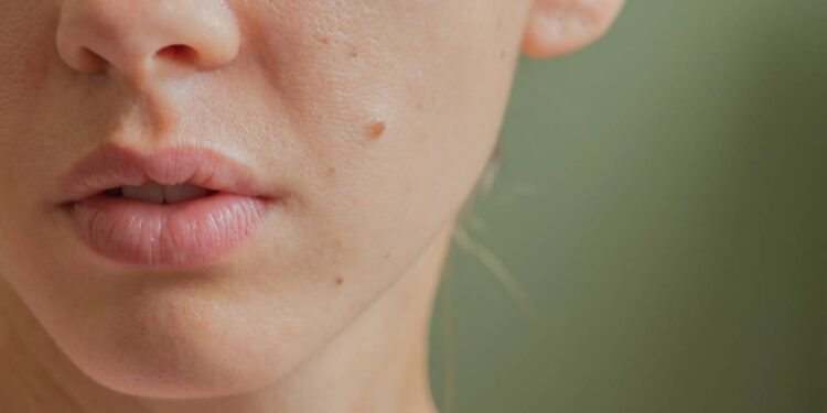 O que significa ter uma pinta perto da boca?