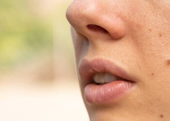 O que significa ter novas pintas no corpo?