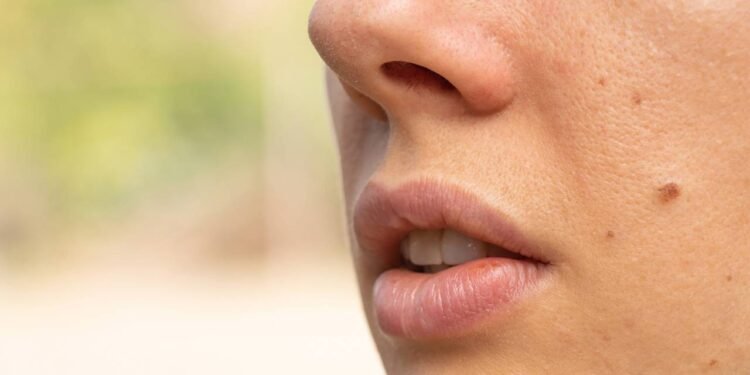 Pintas atípicas, chamados de nevos displásicos, se diferenciam dos pintas comuns por aspectos visuais particulares - Créditos: depositphotos.com / vikabest88@gmail.com