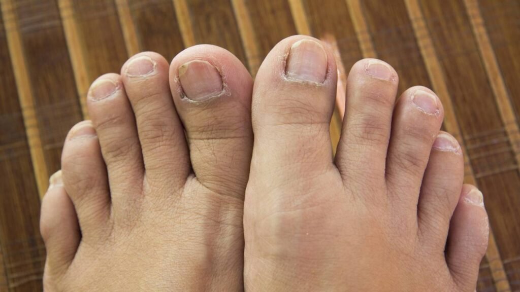 Como remover fungos nas unhas dos pés rapidamente?