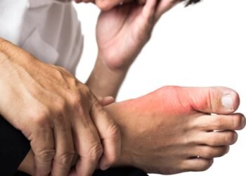 Como baixar o ácido úrico com alimentação e hábitos