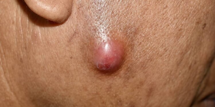 Celulite Facial - Créditos: depositphotos.com / zaynyinyi