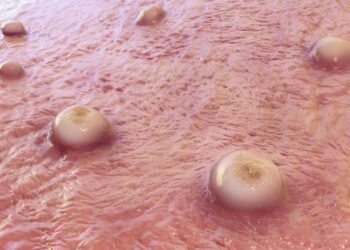 Esse remédio caseiro para furúnculo surpreende médicos