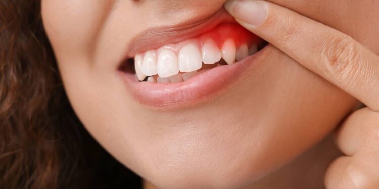 Gengivite - Créditos: depositphotos.com / serezniy