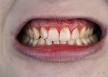 O remédio caseiro mais eficaz para aliviar a Gengivite