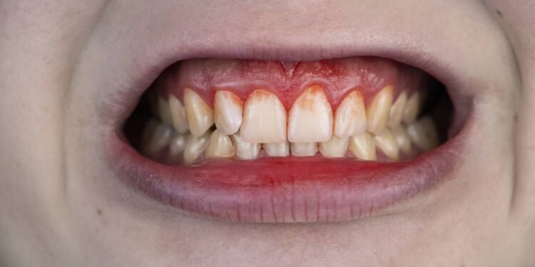 O sinal na escovação que alerta para gengivite - Créditos: depositphotos.com / Alena1919