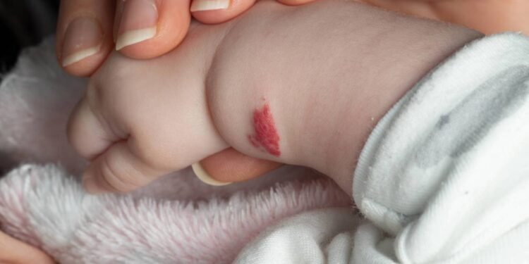 Hemangiomas Cavernosos - Créditos: depositphotos.com / VictorMulero