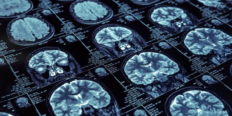 Neurocirurgia Oncológica - Créditos: depositphotos.com / Nomadsoul1