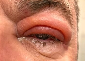 6 remédios caseiros eficazes para tratar o terçol