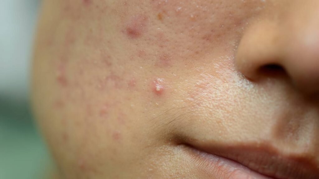 O que realmente são espinhas e cravos e como controlar?