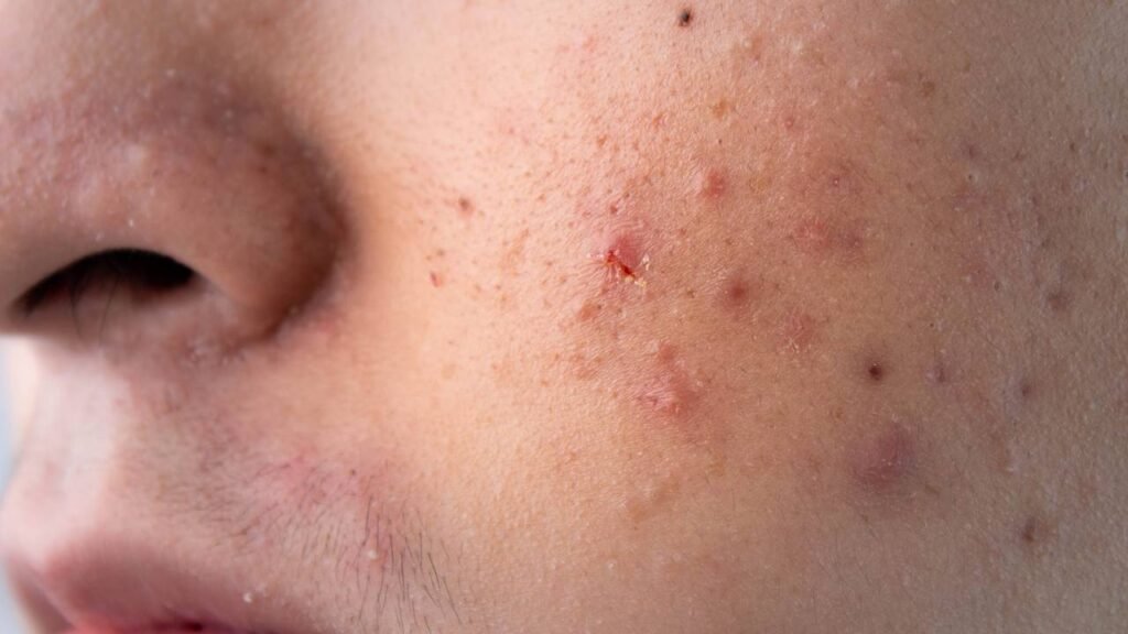 O que realmente são espinhas e cravos e como controlar?