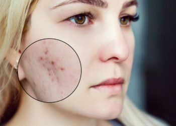 O que realmente são espinhas e cravos e como controlar?