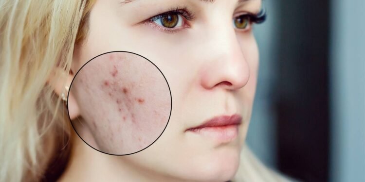 O que realmente são espinhas e cravos e como controlar?