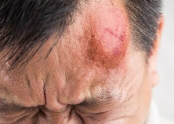 Entenda os riscos invisíveis que podem surgir dias depois de uma Pancada na Cabeça