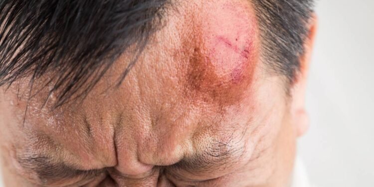 Pancada na cabeça - Créditos: depositphotos.com / Thamkc