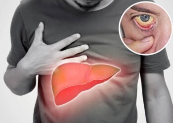 Sintomas iniciais da gordura no fígado que passam despercebidos