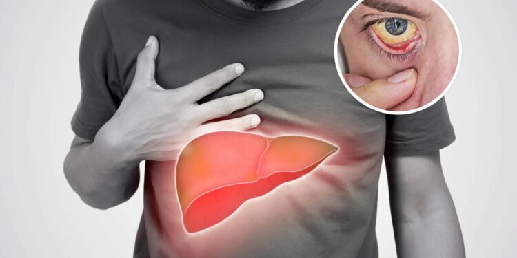 Sintomas iniciais da gordura no fígado que passam despercebidos