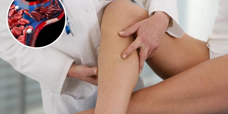 Os verdadeiros sintomas iniciais de problemas na circulação das pernas