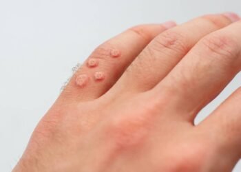 3 remédios caseiros para remover “Olho de Peixe”