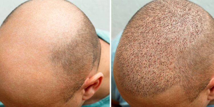 Transplantes capilares - Créditos: depositphotos.com / arribalko