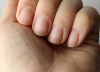 O que unhas amarelas dizem sobre sua saúde?