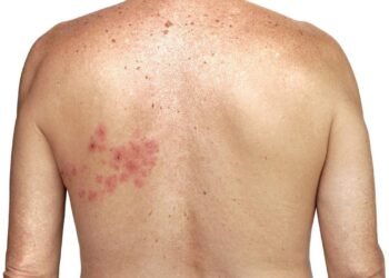 Herpes zóster tem cura? Veja o que realmente ajuda