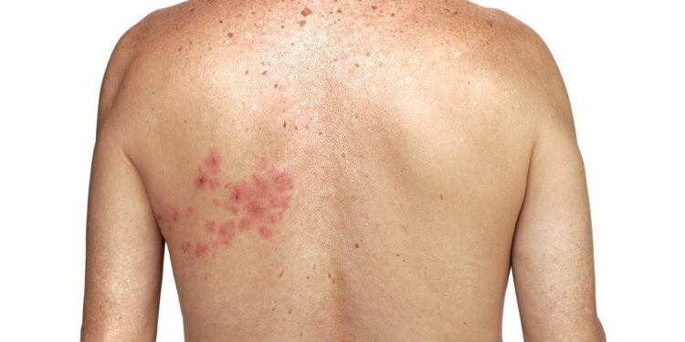 Herpes Zóster - Créditos: depositphotos.com / vanploy