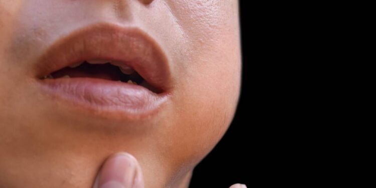 Parotidite - Créditos: depositphotos.com / zaynyinyi