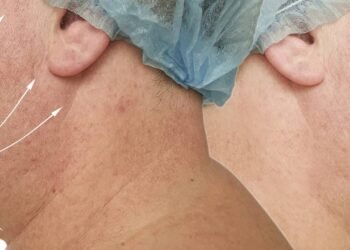 O tratamento facial mais buscado por homens modernos