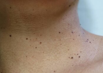 A verruga mais comum que muita gente confunde com pinta