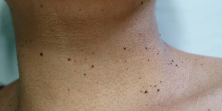 Verrugas Pigmentadas - Créditos: depositphotos.com / Octopus16