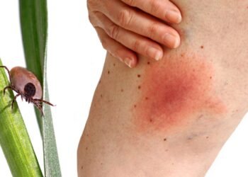 Atrito entre as coxas causa assadura? Entenda